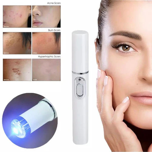 πβ¨ Blue-Ray Acne Treatment Pen